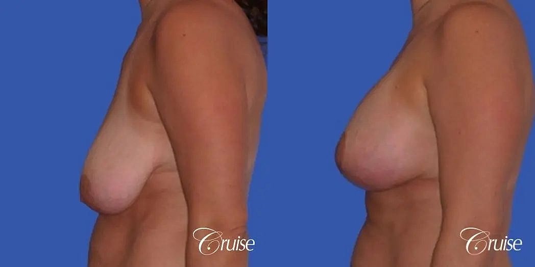 Breast Lift Augmentation Before & After