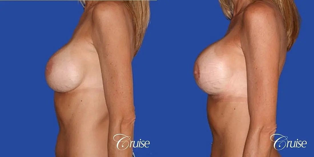 Breast Lift Augmentation Before & After