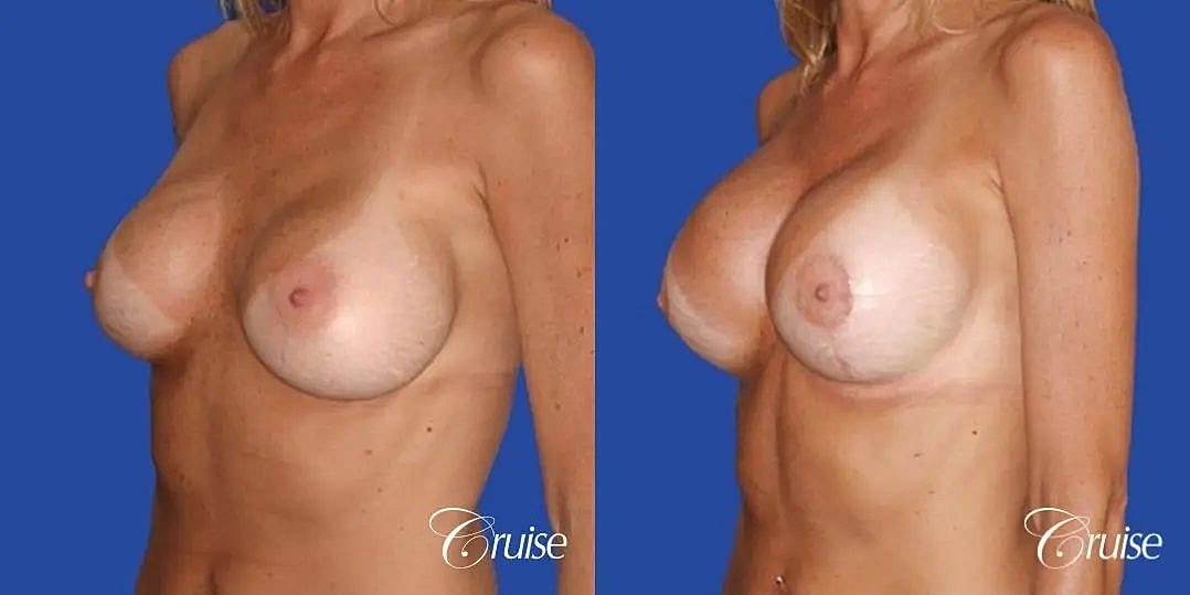 Breast Lift Augmentation Before & After