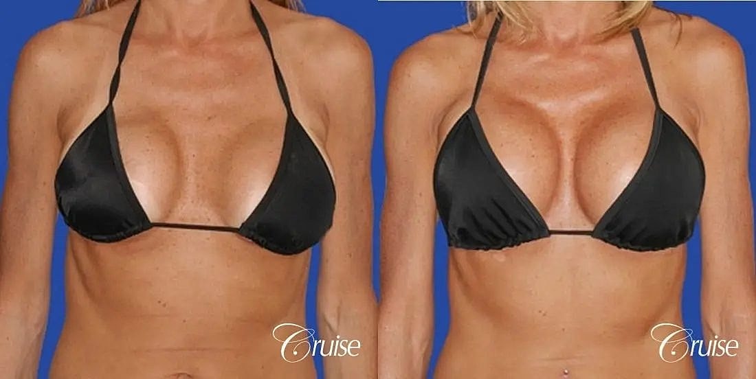 Breast Lift Augmentation Before & After