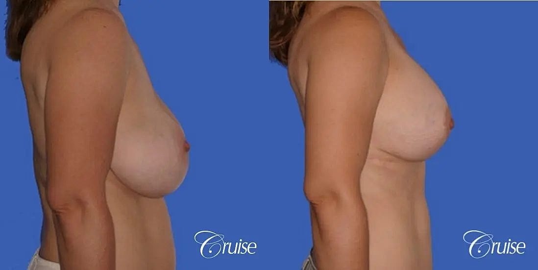 Breast Lift Augmentation Before & After