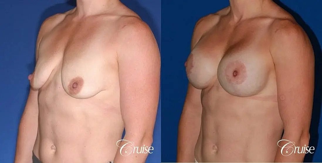 Breast Lift Augmentation Before & After