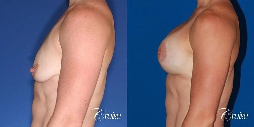 Breast Lift Augmentation Before & After