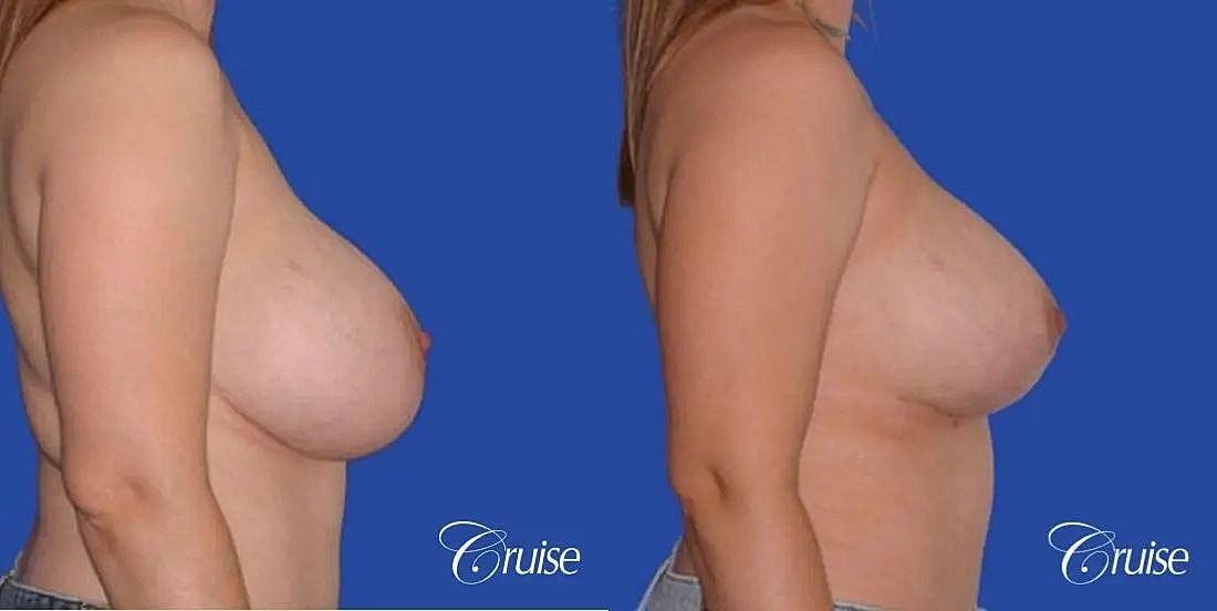 Breast Lift Augmentation Before & After