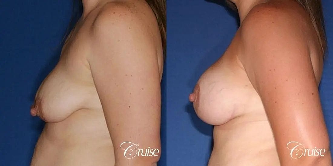 Breast Lift Augmentation Before & After