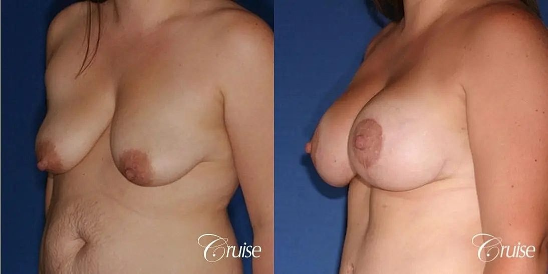 Breast Lift Augmentation Before & After
