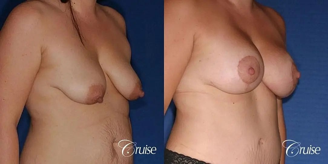 Breast Lift Augmentation Before & After