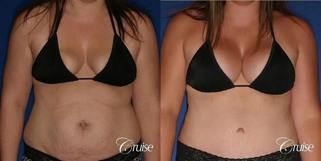 Breast Lift Augmentation Before & After
