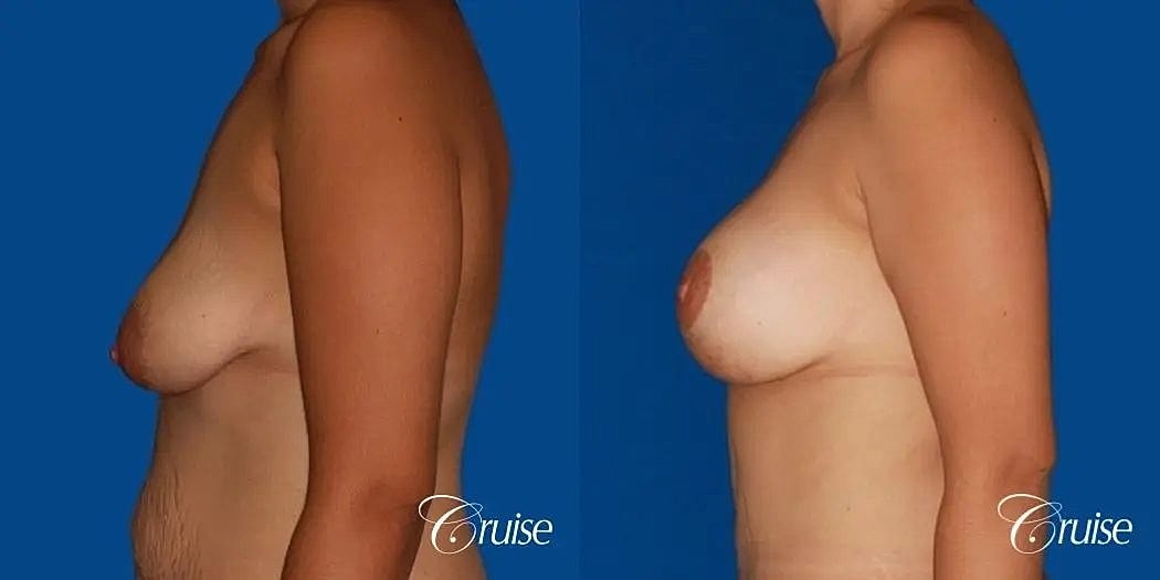 Breast Lift Augmentation Before & After