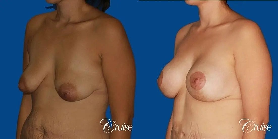 Breast Lift Augmentation Before & After