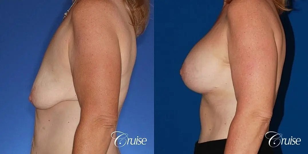 Breast Lift Augmentation Before & After