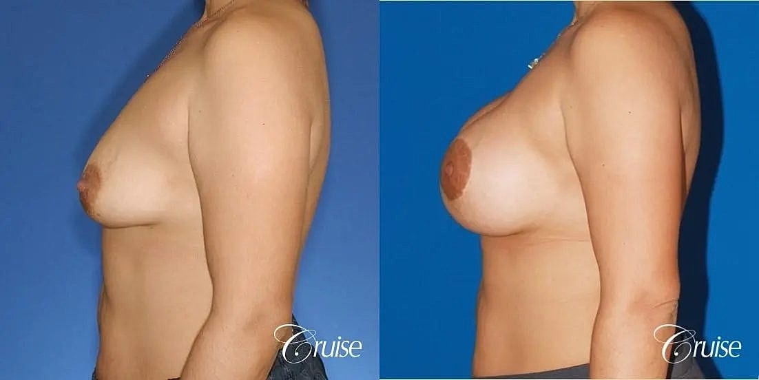 Breast Lift Augmentation Before & After