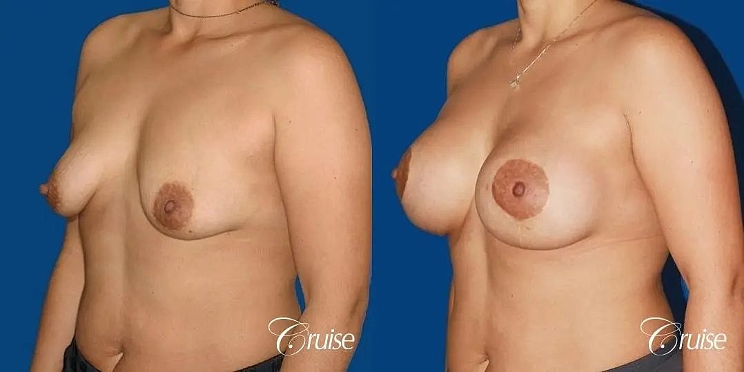 Breast Lift Augmentation Before & After