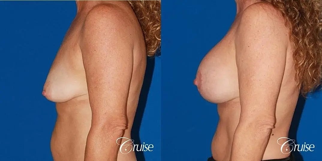 Breast Lift Augmentation Before & After