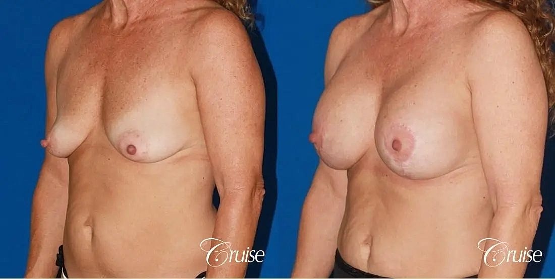 Breast Lift Augmentation Before & After