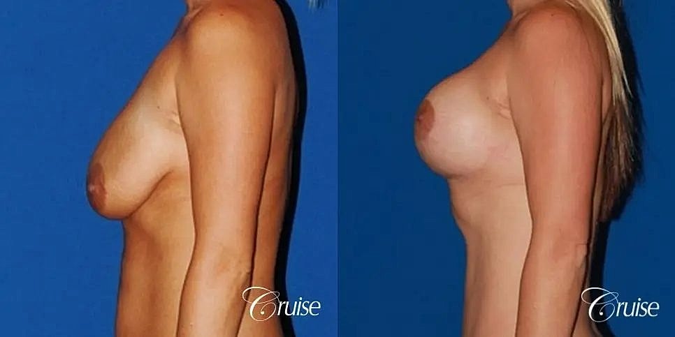 Breast Lift Augmentation Before & After