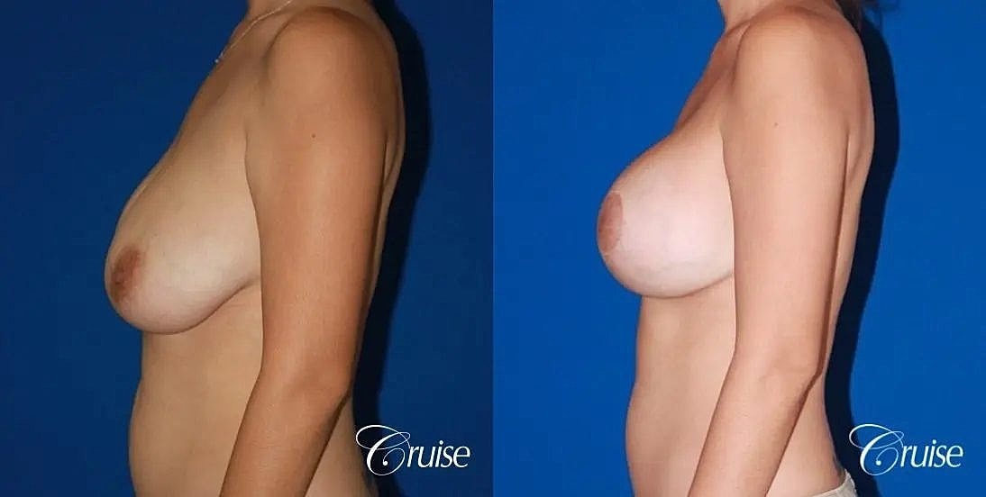 Breast Lift Augmentation Before & After