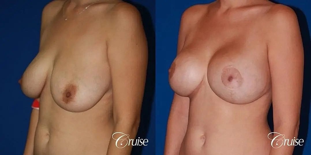 Breast Lift Augmentation Before & After