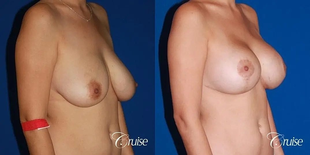 Breast Lift Augmentation Before & After