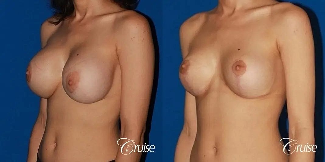 Breast Lift Augmentation Before & After