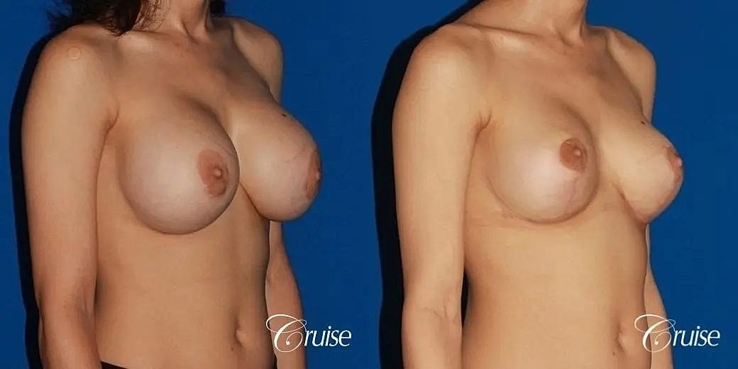 Breast Lift Augmentation Before & After