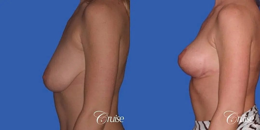 Breast Lift Augmentation Before & After