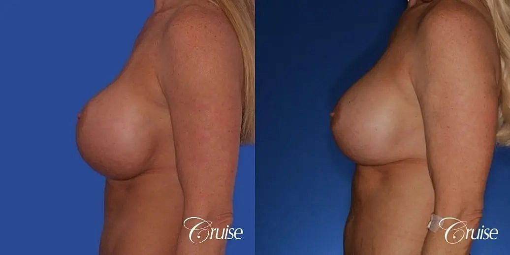 Breast Lift Augmentation Before & After