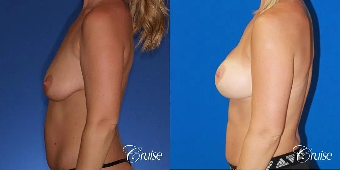 Breast Lift Augmentation Before & After