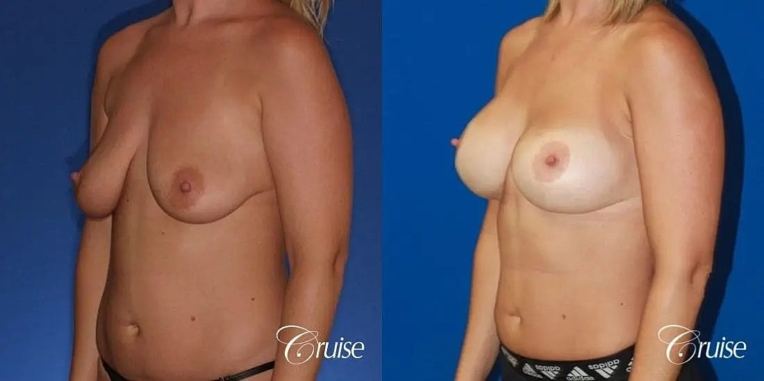 Breast Lift Augmentation Before & After