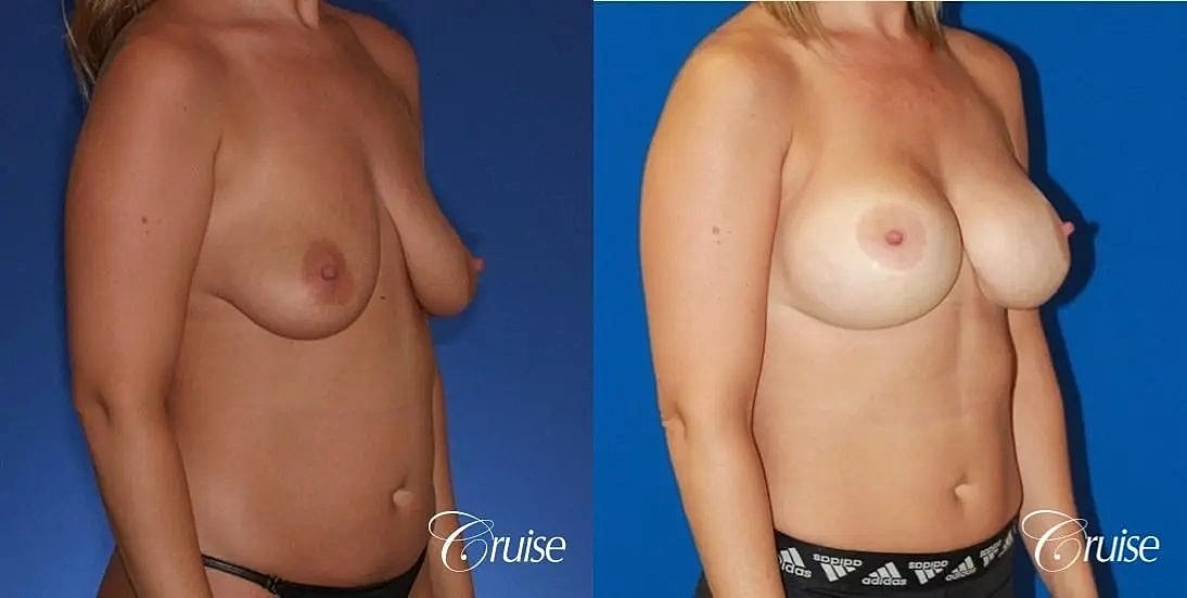 Breast Lift Augmentation Before & After