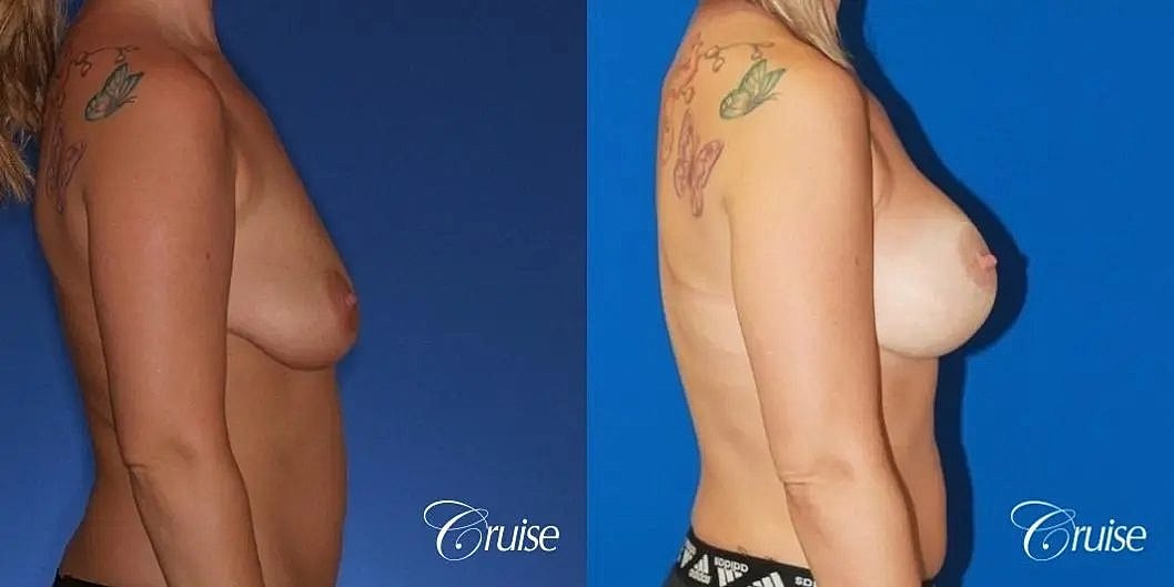 Breast Lift Augmentation Before & After