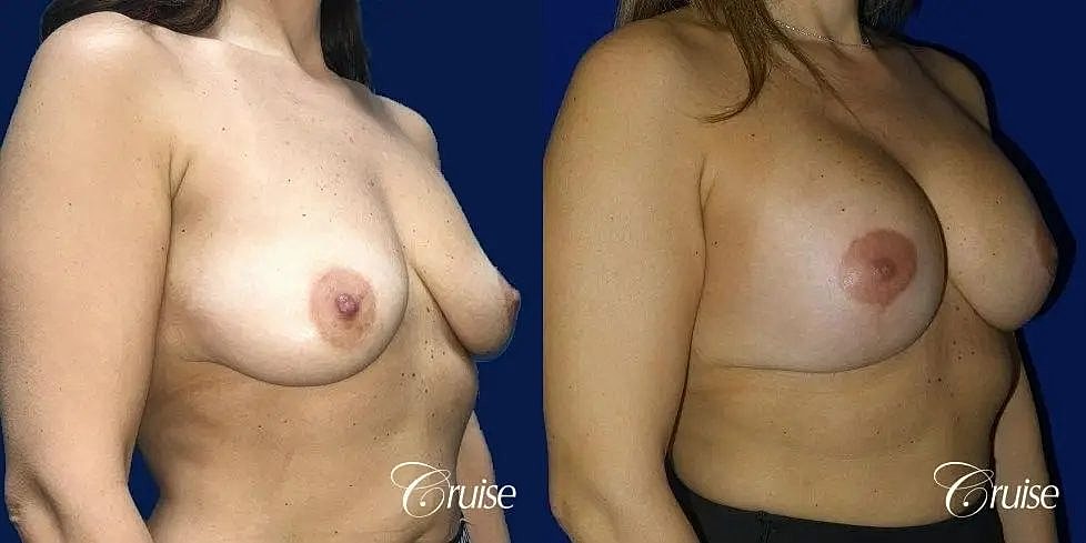 Breast Lift Augmentation Before & After