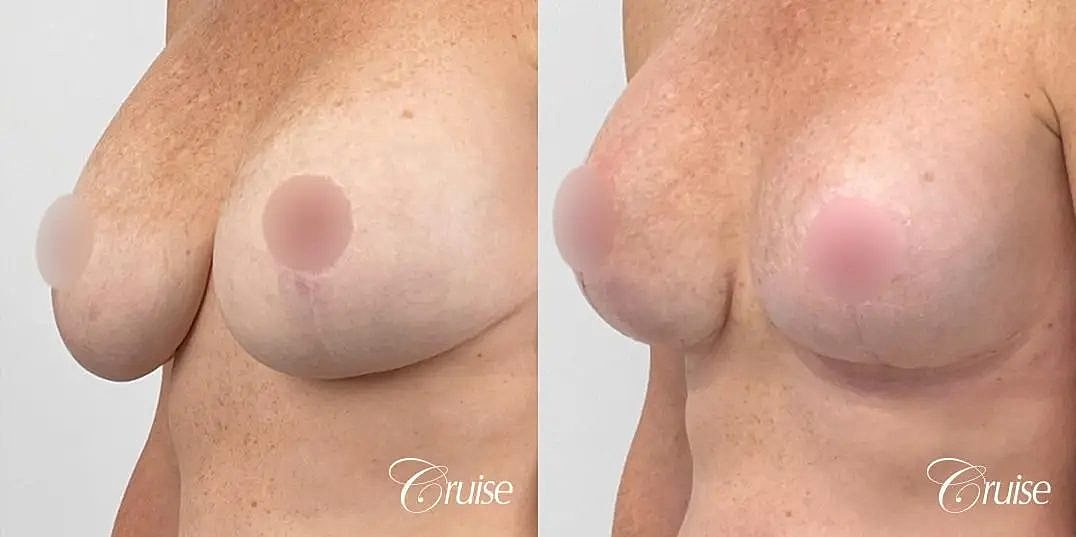 Breast Lift Augmentation Before & After
