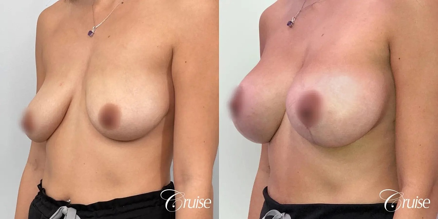 Breast Lift Augmentation Before & After