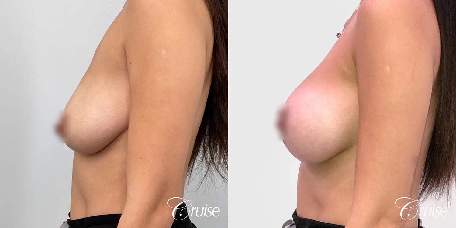 Breast Lift Augmentation Before & After