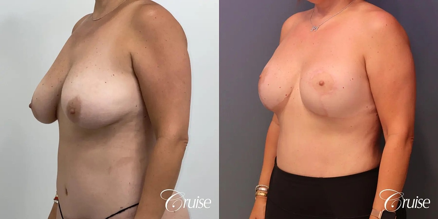 Breast Lift Augmentation Before & After