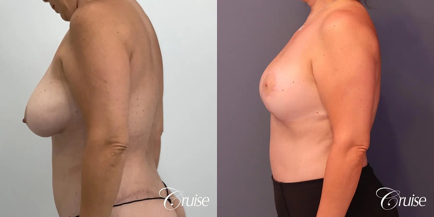 Breast Lift Augmentation Before & After