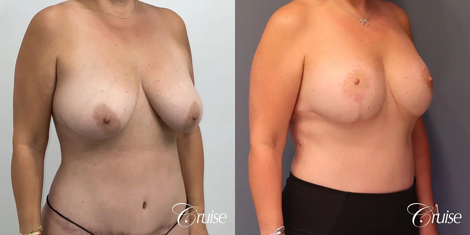 Breast Lift Augmentation Before & After