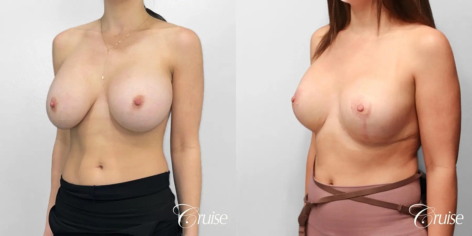 Breast Lift Augmentation Before & After