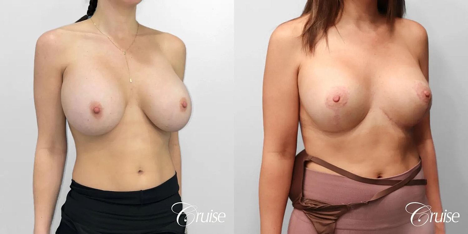 Breast Lift Augmentation Before & After