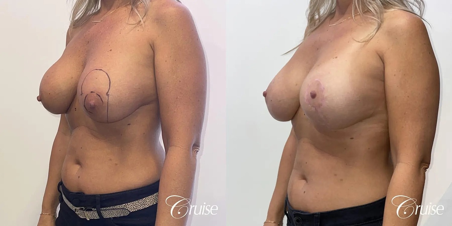 Breast Lift Augmentation Before & After