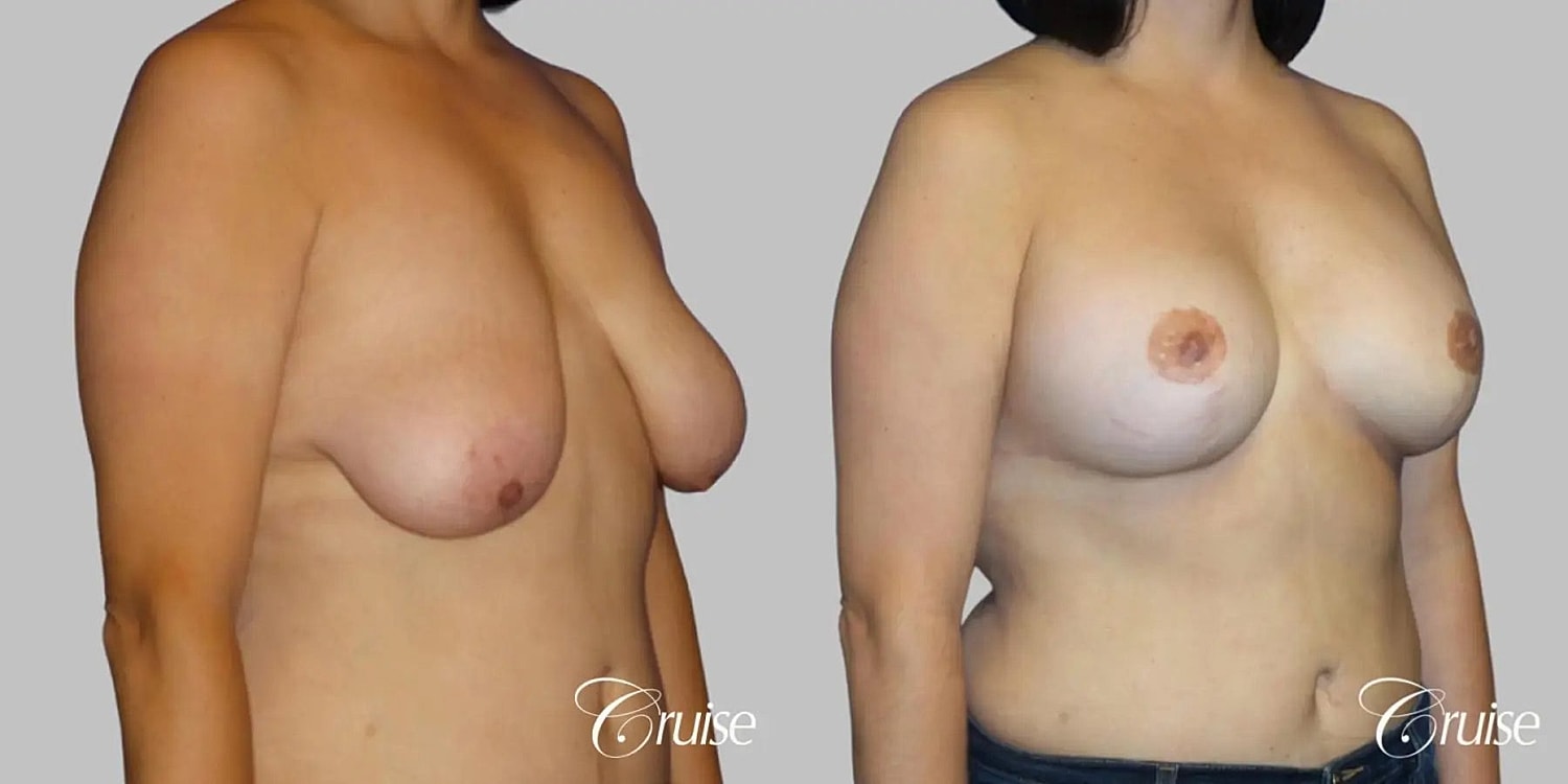 Breast Lift Augmentation Before & After