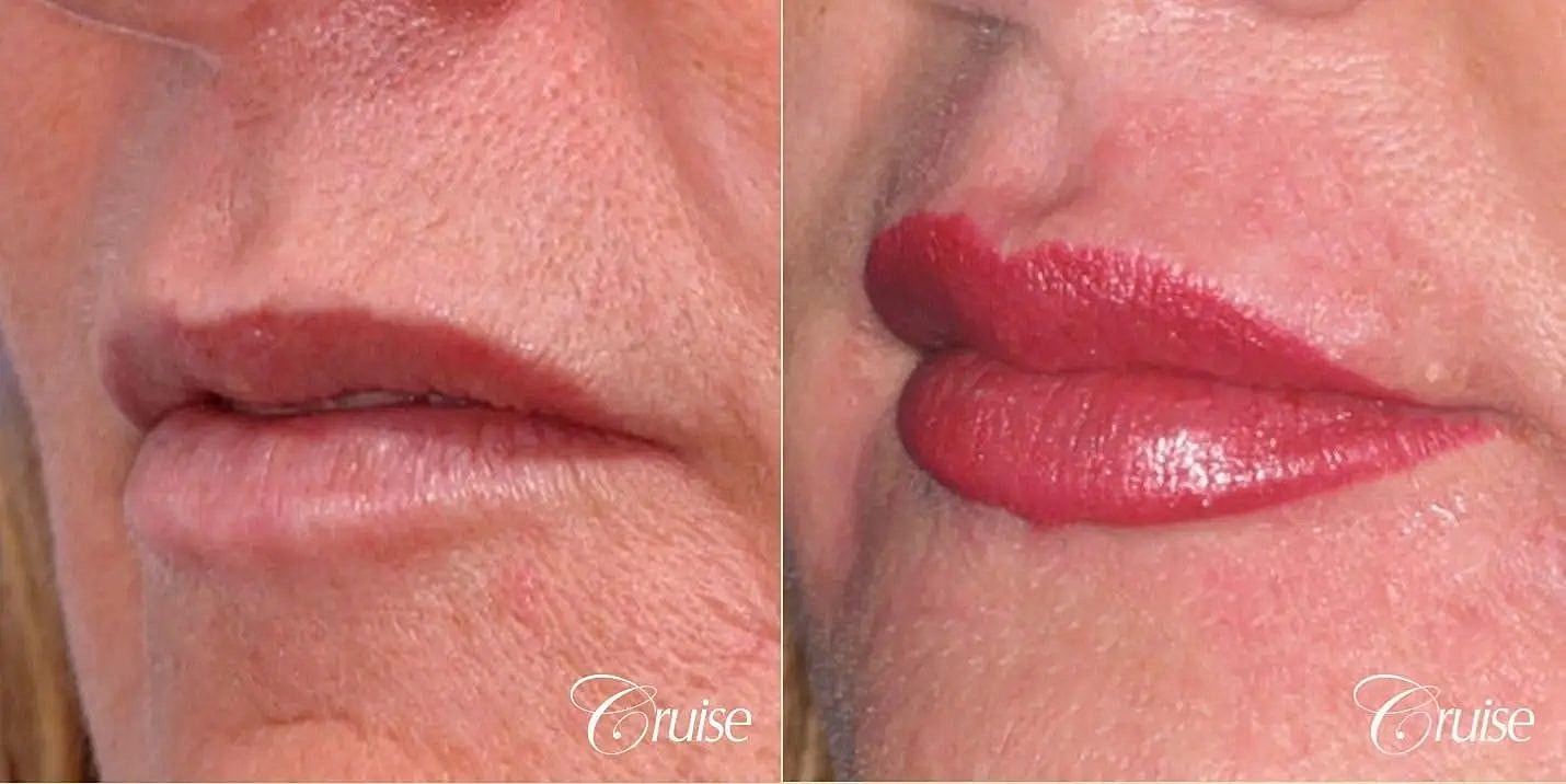 Lip Filler Before & After