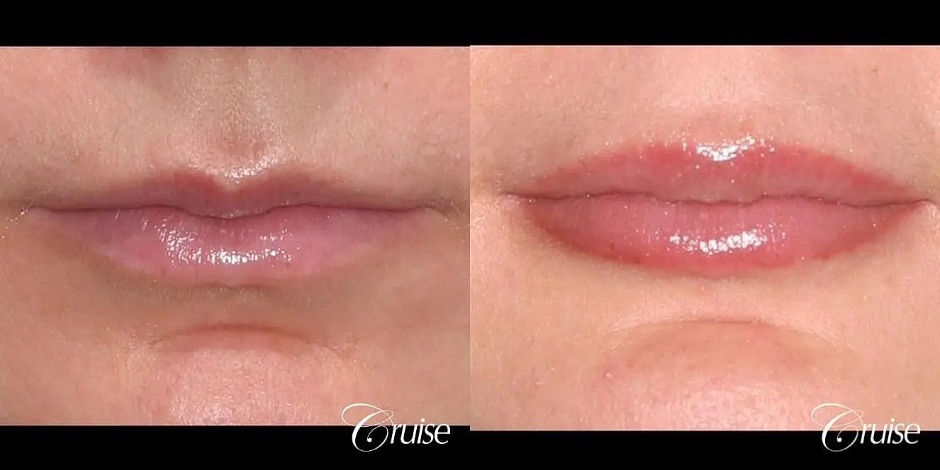 Lip Filler Before & After