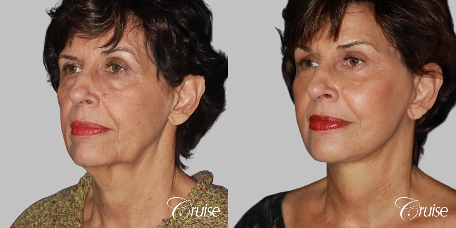 Neck Lift Before & After
