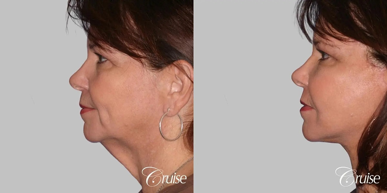 Neck Lift Before & After