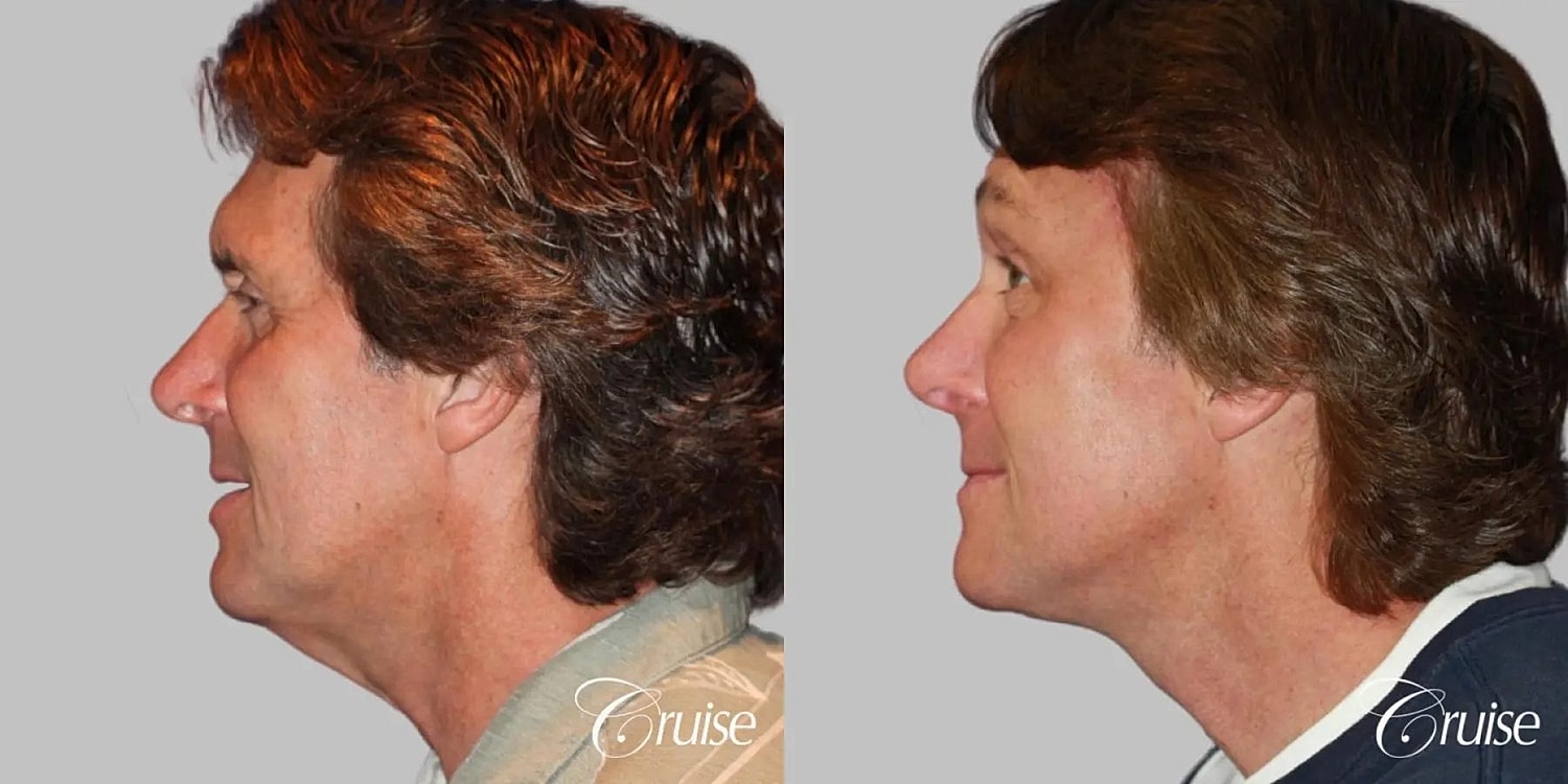 Neck Lift Before & After