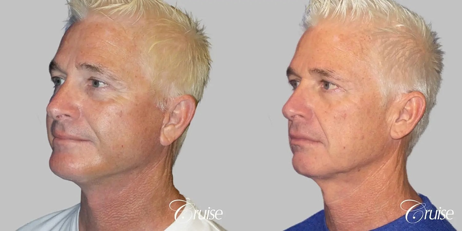 Neck Lift Before & After