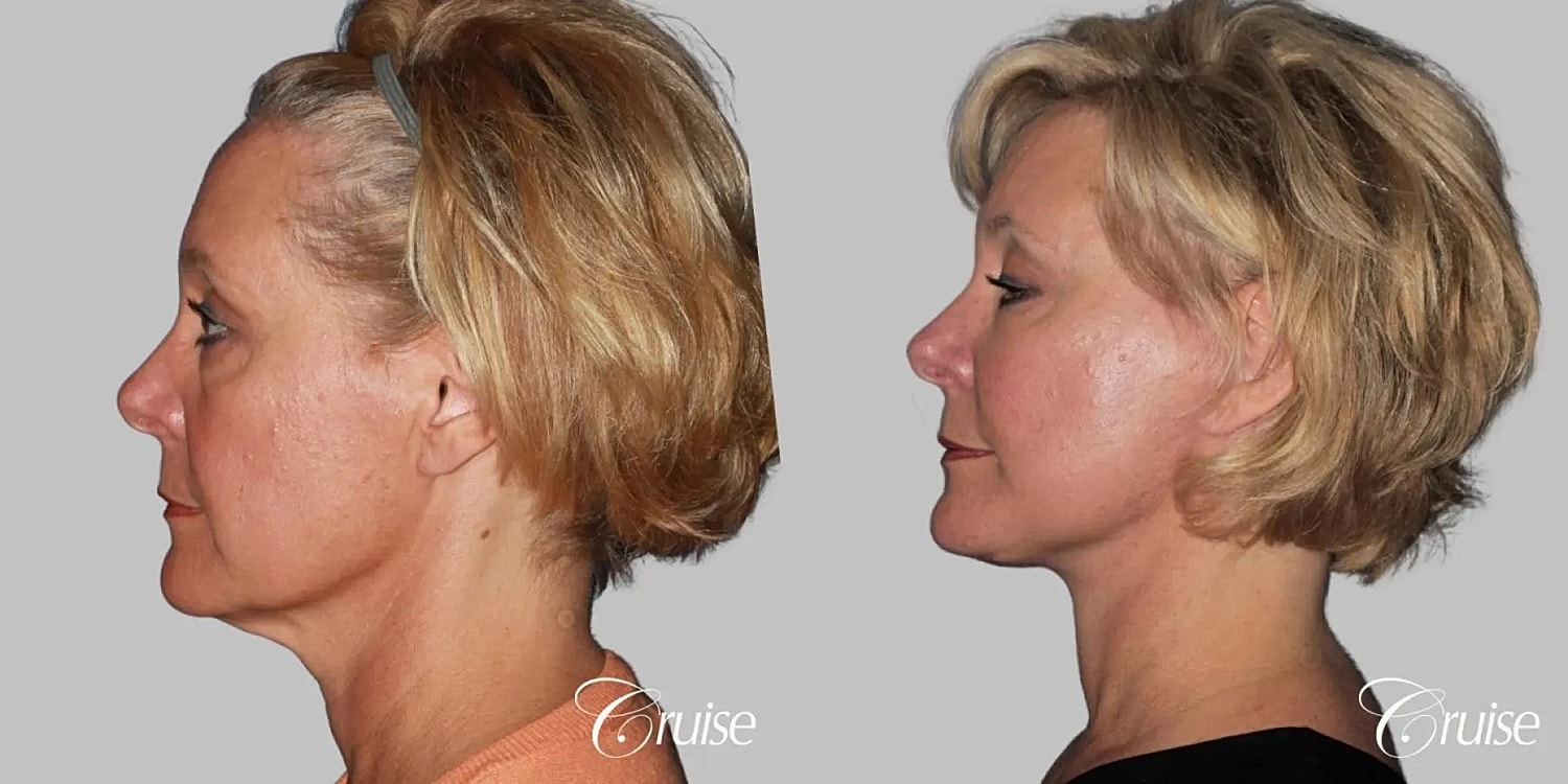 Neck Lift Before & After