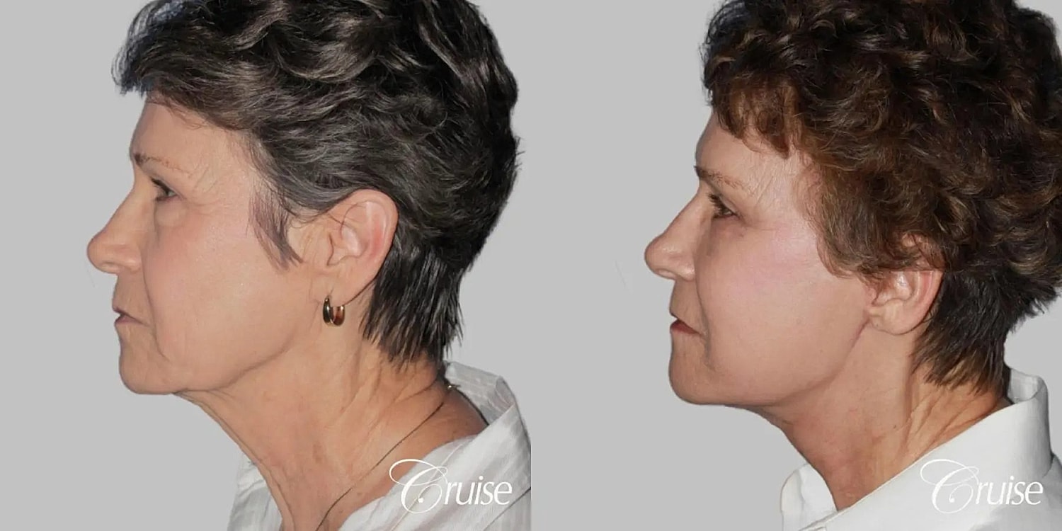 Neck Lift Before & After